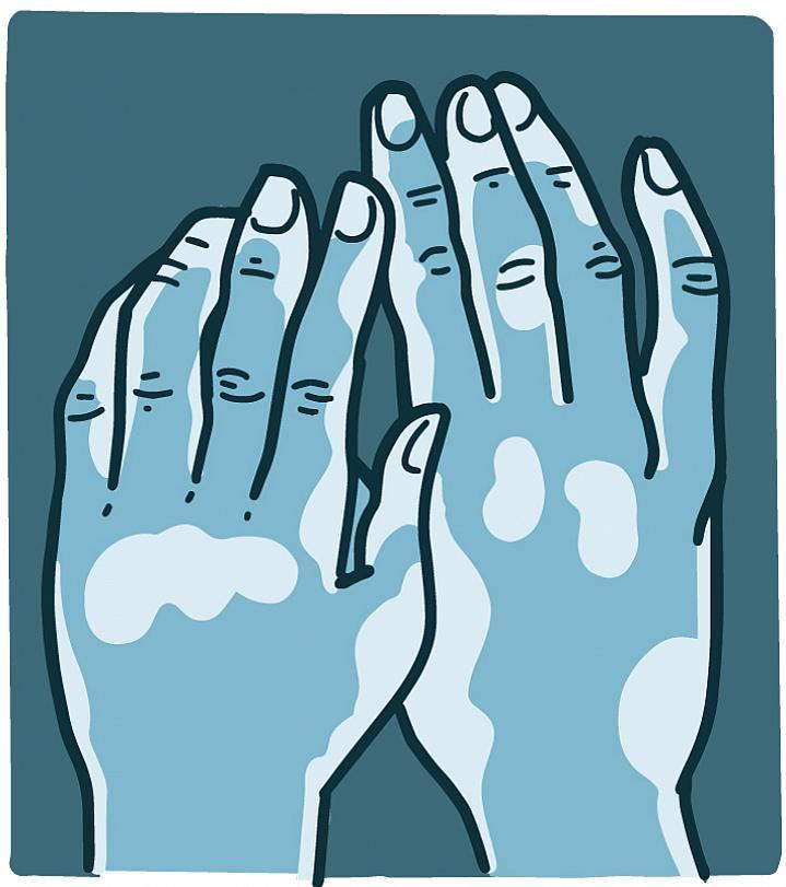 Ilustración de manos con manchas de vitíligo.