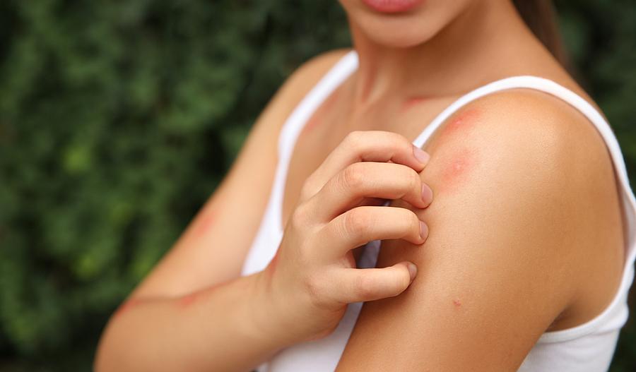 Imagen de una mujer rascándose las picaduras de mosquito en el brazo.
