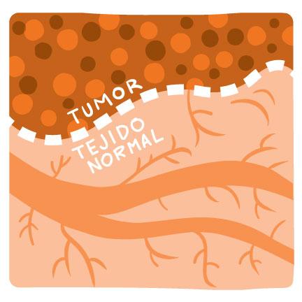 Ilustración que muestra una línea clara entre el tejido tumoral y el tejido normal.