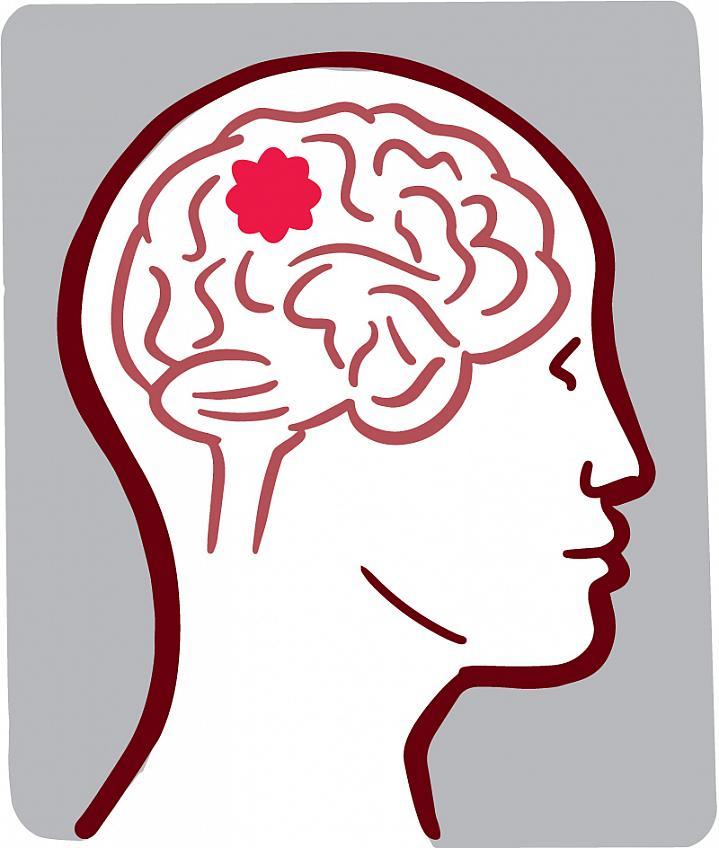 Ilustración de un tumor cerebral