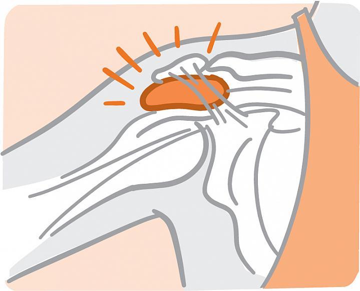 Ilustración de una bursa en una articulación del hombro.
