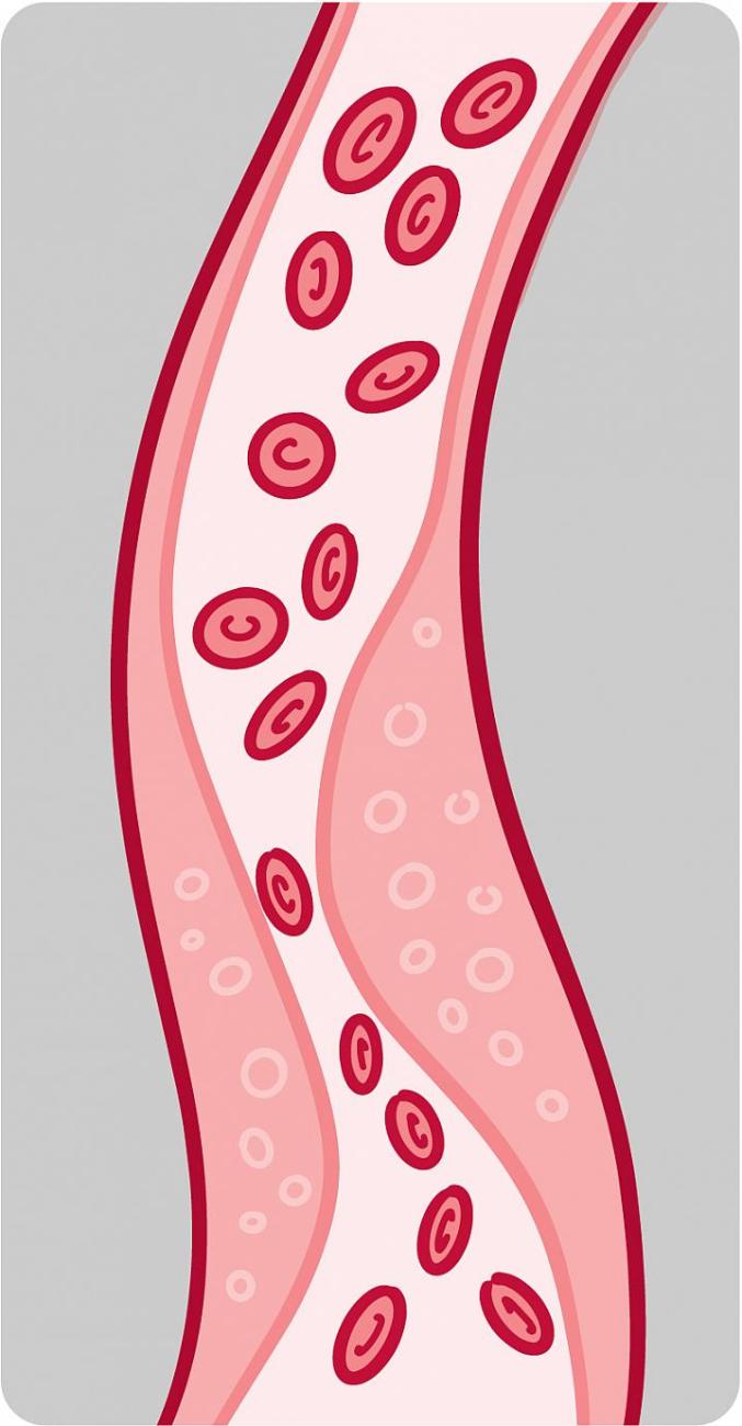 Ilustración de un vaso sanguíneo con acumulación de placa.