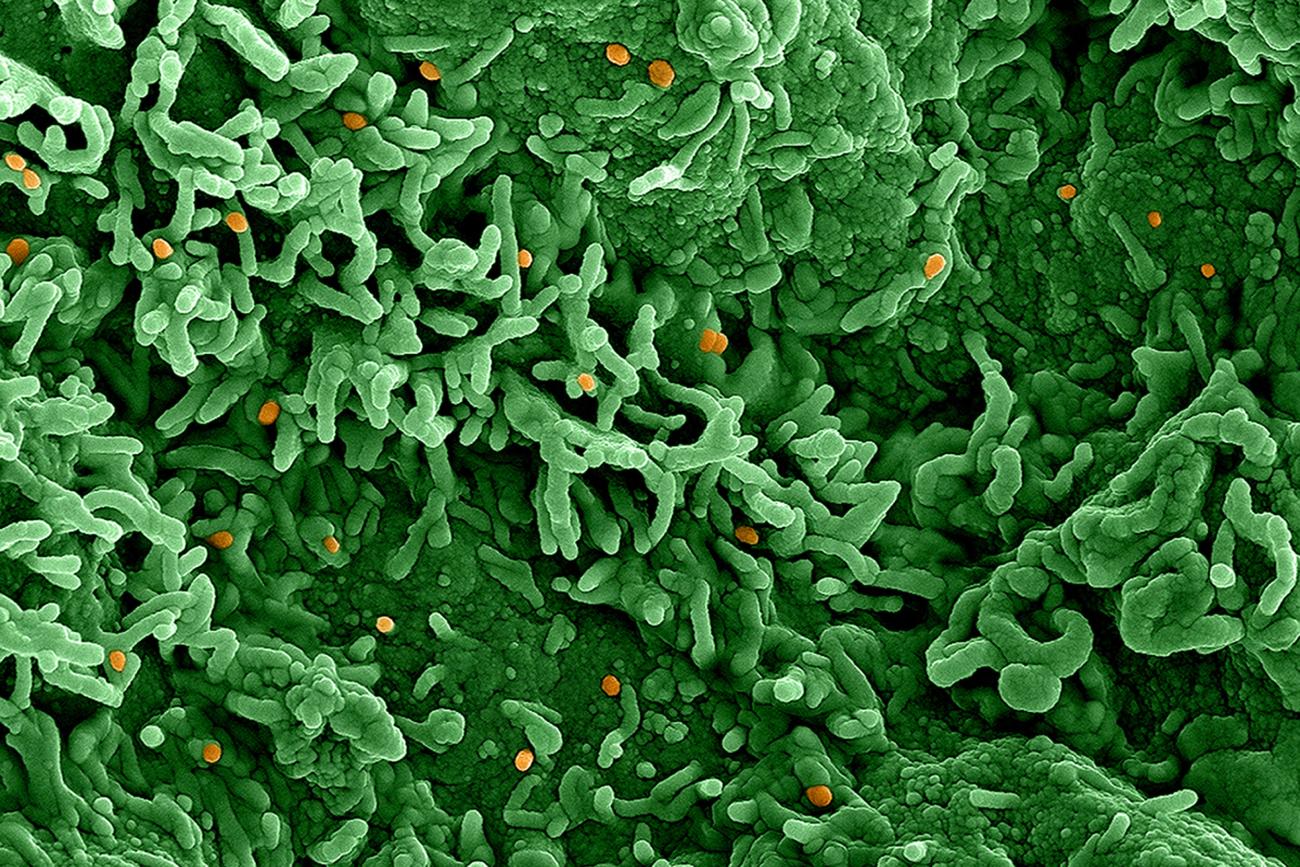 Imagen del virus de la viruela del simio (naranja) en células infectadas