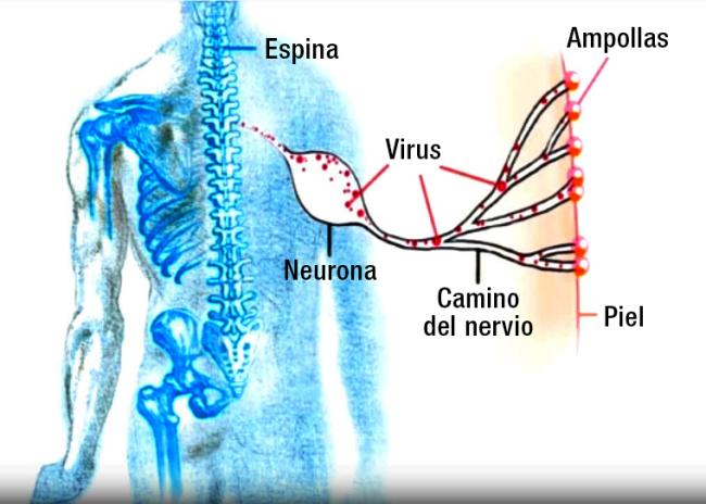 Ilustración del camino del herpes zóster en el cuerpo