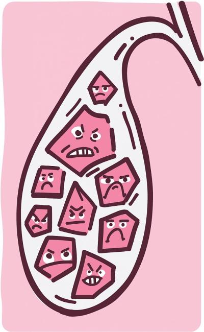 Ilustración de cálculos biliares dentro de la vesícula biliar.