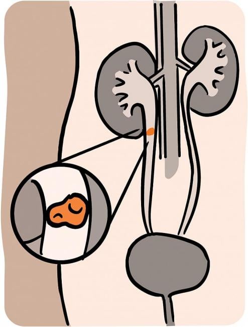Ilustración de un cálculo renal en el tracto urinario.