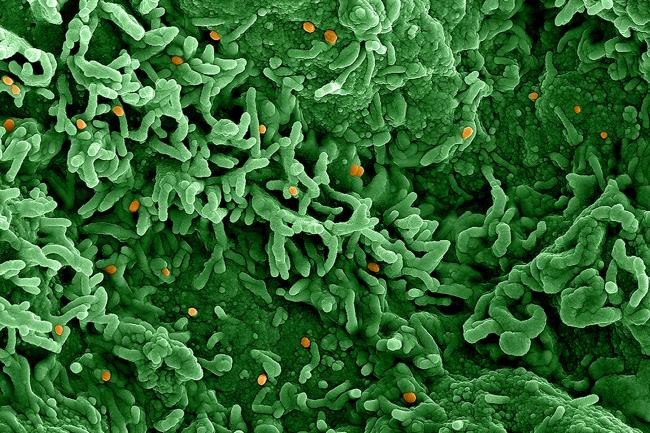 Imagen del virus de la viruela del simio (naranja) en células infectadas