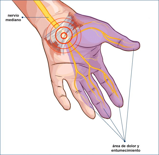 Una ilustración de una mano con el síndrome del túnel carpiano.