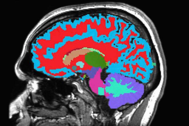 Una imagen de resonancia magnética (MRI, por sus siglas en inglés) del cerebro.