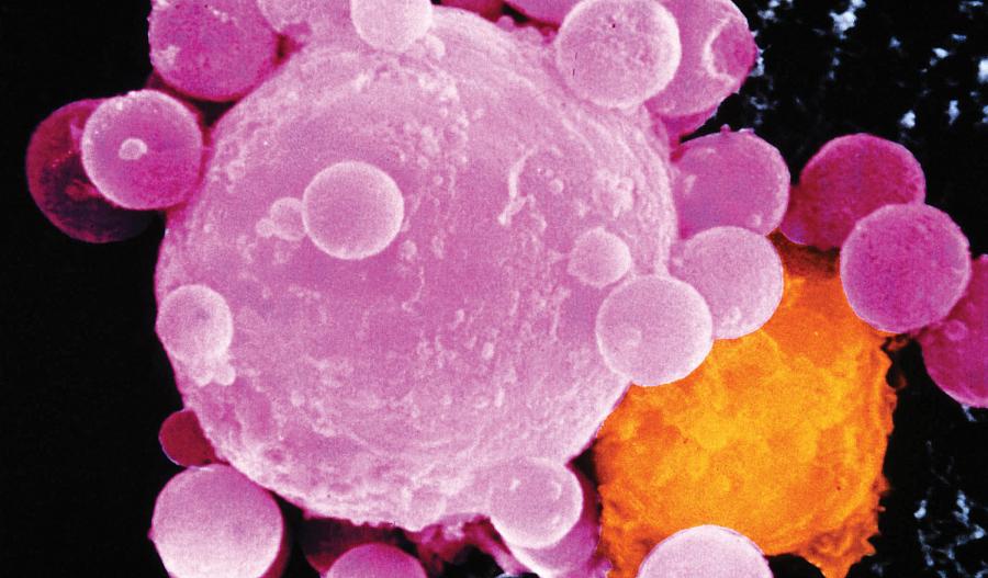Linfocitos atacando una célula cancerosa