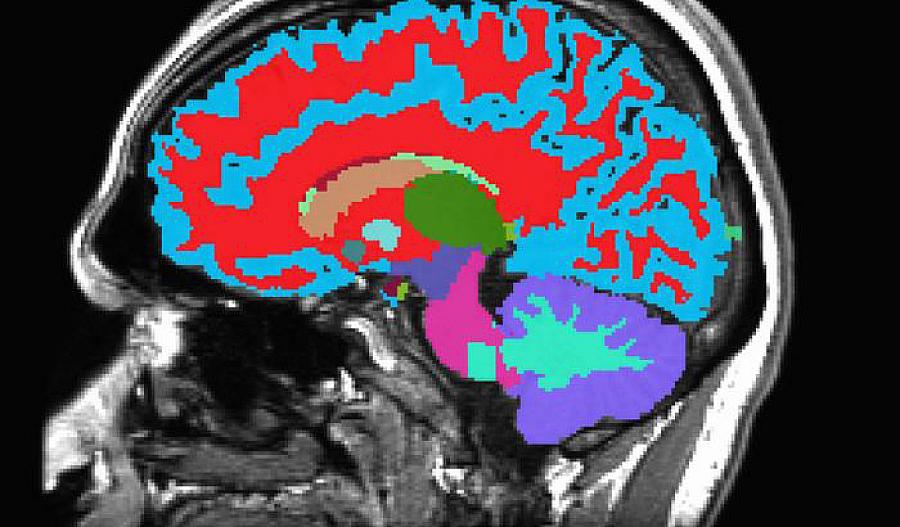 Una imagen de resonancia magnética (MRI, por sus siglas en inglés) del cerebro.